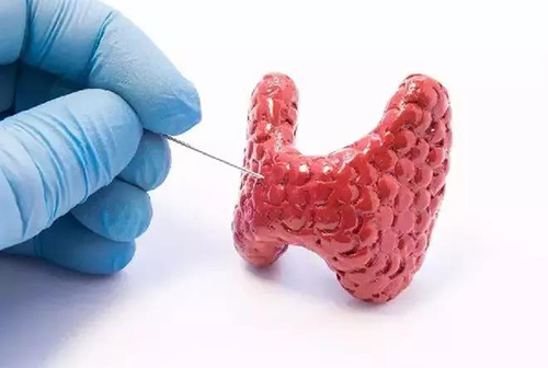 甲状腺疾病，蕴含甲状腺职能减退和甲状腺职能亢进，自古以来就是反复被医学钻研人员钻研的疾病